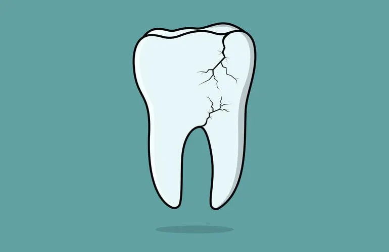 How to fix a cracked tooth: your complete guide