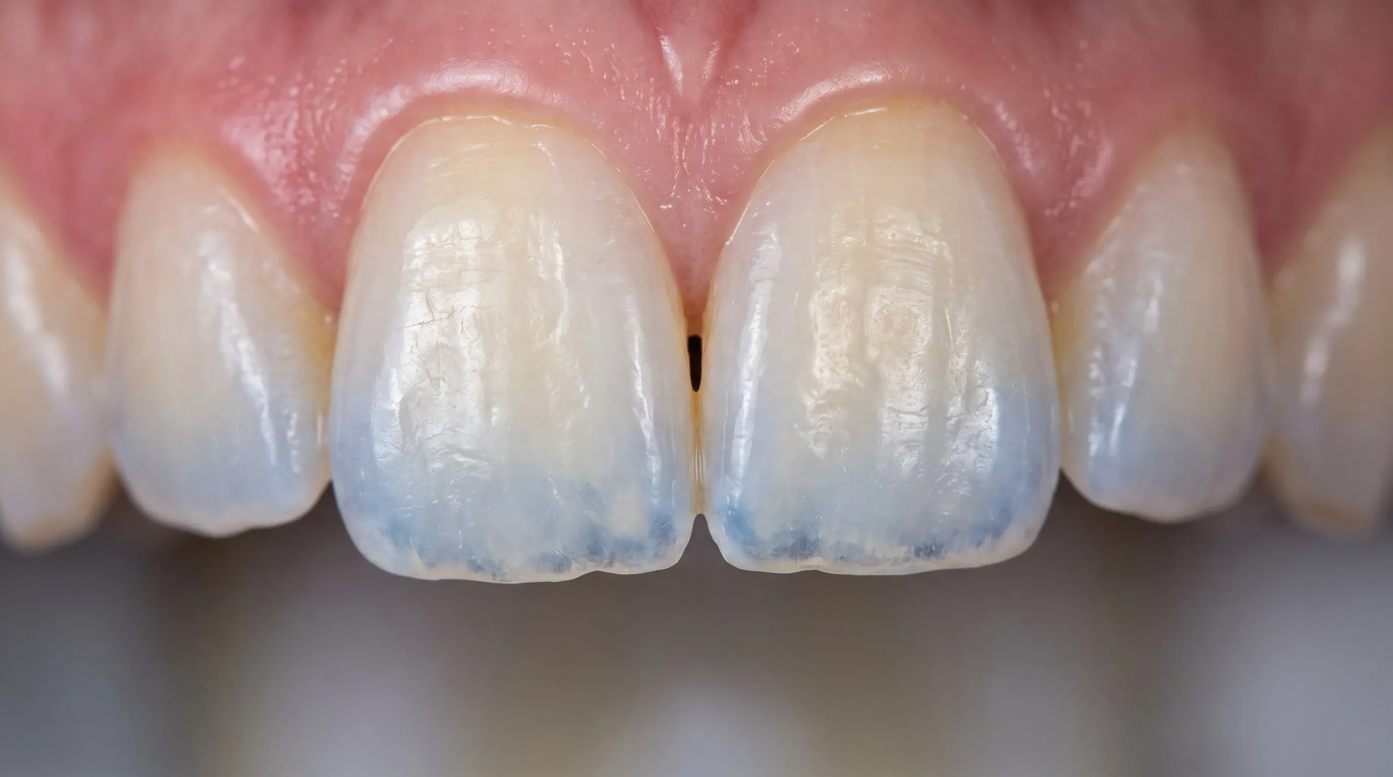 Close-up de dentes com esmalte fino nas bordas, examinados na Neola Dental, Minneola, FL