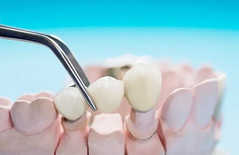 Dental Crown Procedure Equipment - Neola Dental