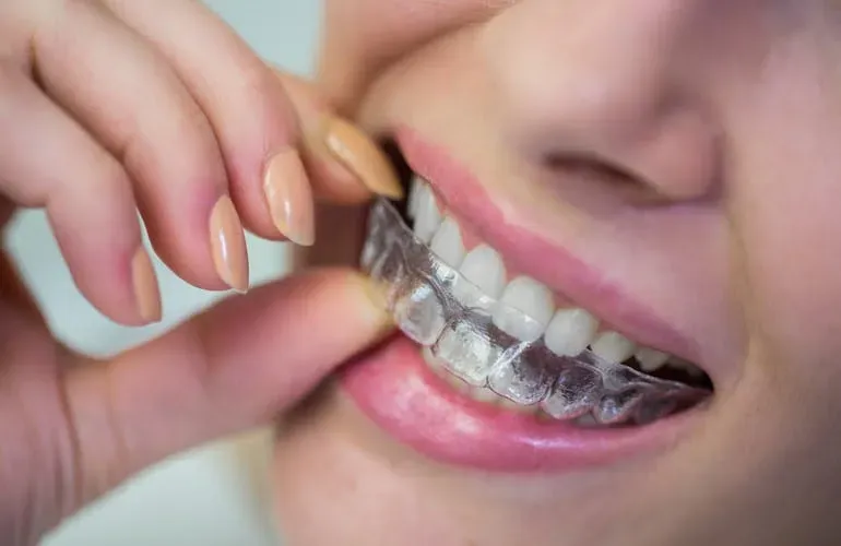 How long does it take for Invisalign to work?