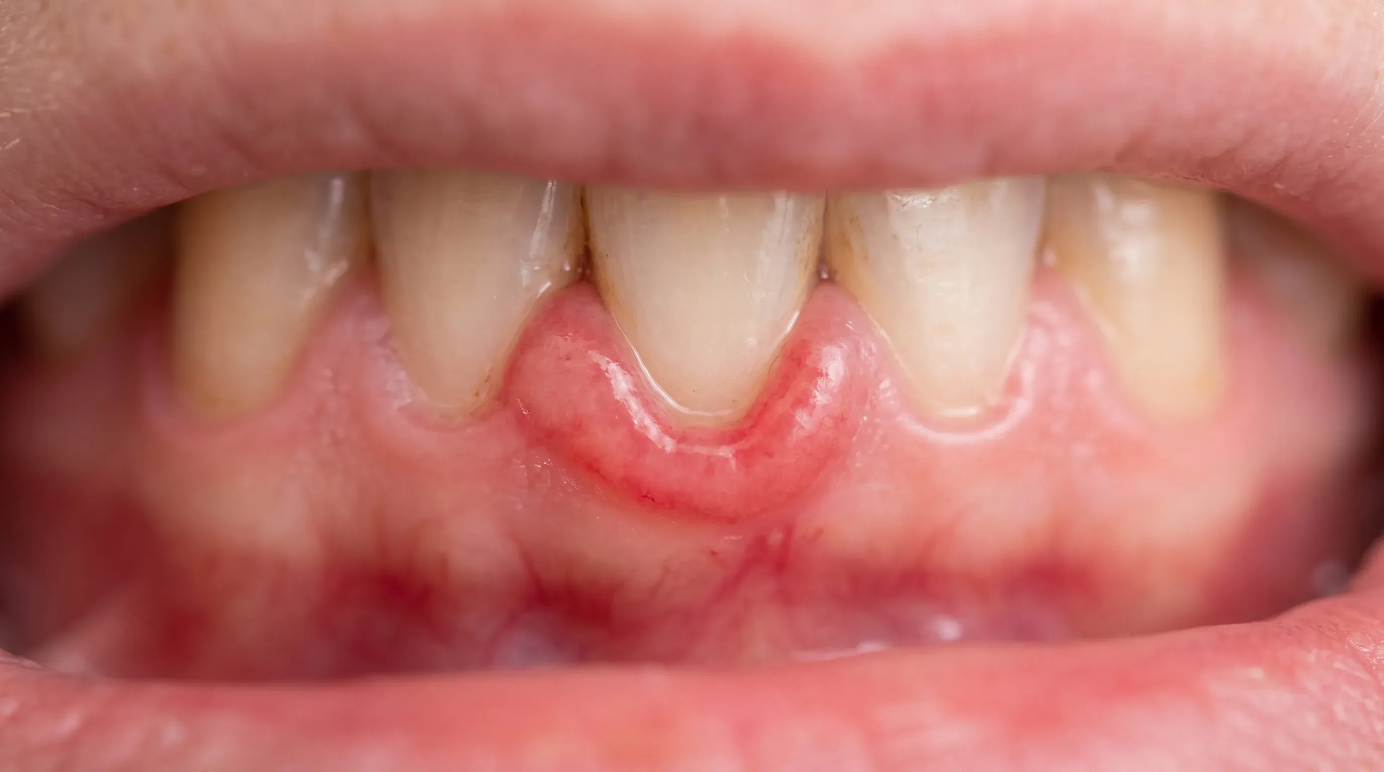 Close-up of inflamed gum tissue swollen around a single tooth, examined at Neola Dental in Minneola, FL