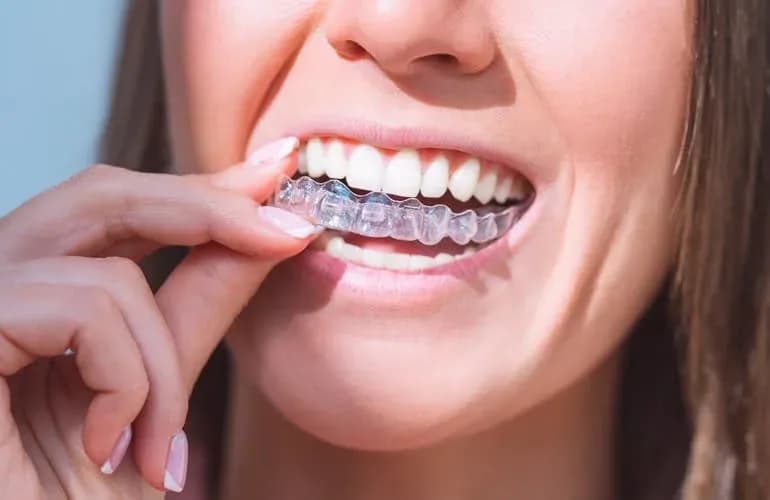 Close-up of a woman with a flawless white smile — porcelain and composite veneers at Neola Dental in Minneola, FL