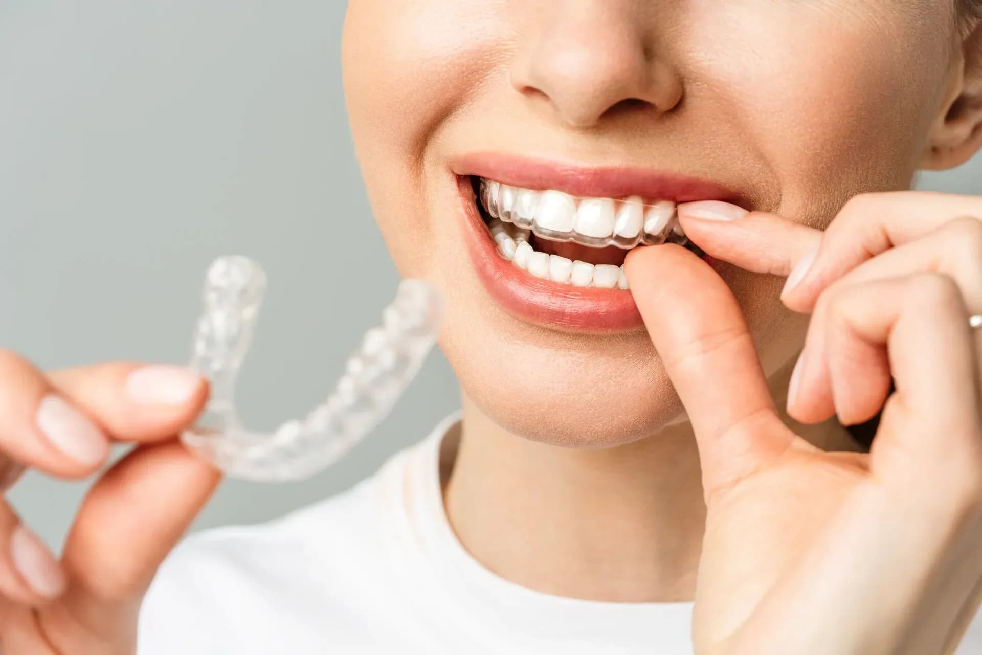 Young woman holding a teeth whitening tray with gel — professional teeth whitening at Neola Dental in Minneola, FL