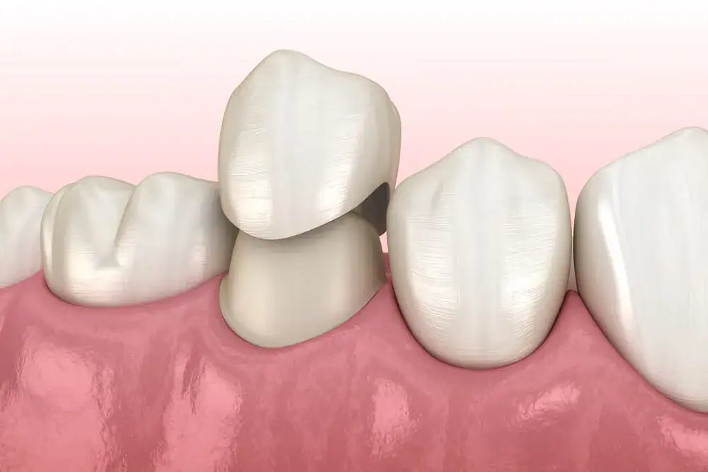 BruxZir Zirconia Crown - Neola Dental