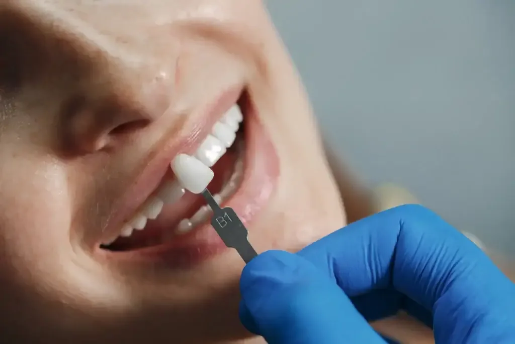 Porcelain Veneers in Minneola at Neola Dental in Minneola, FL
