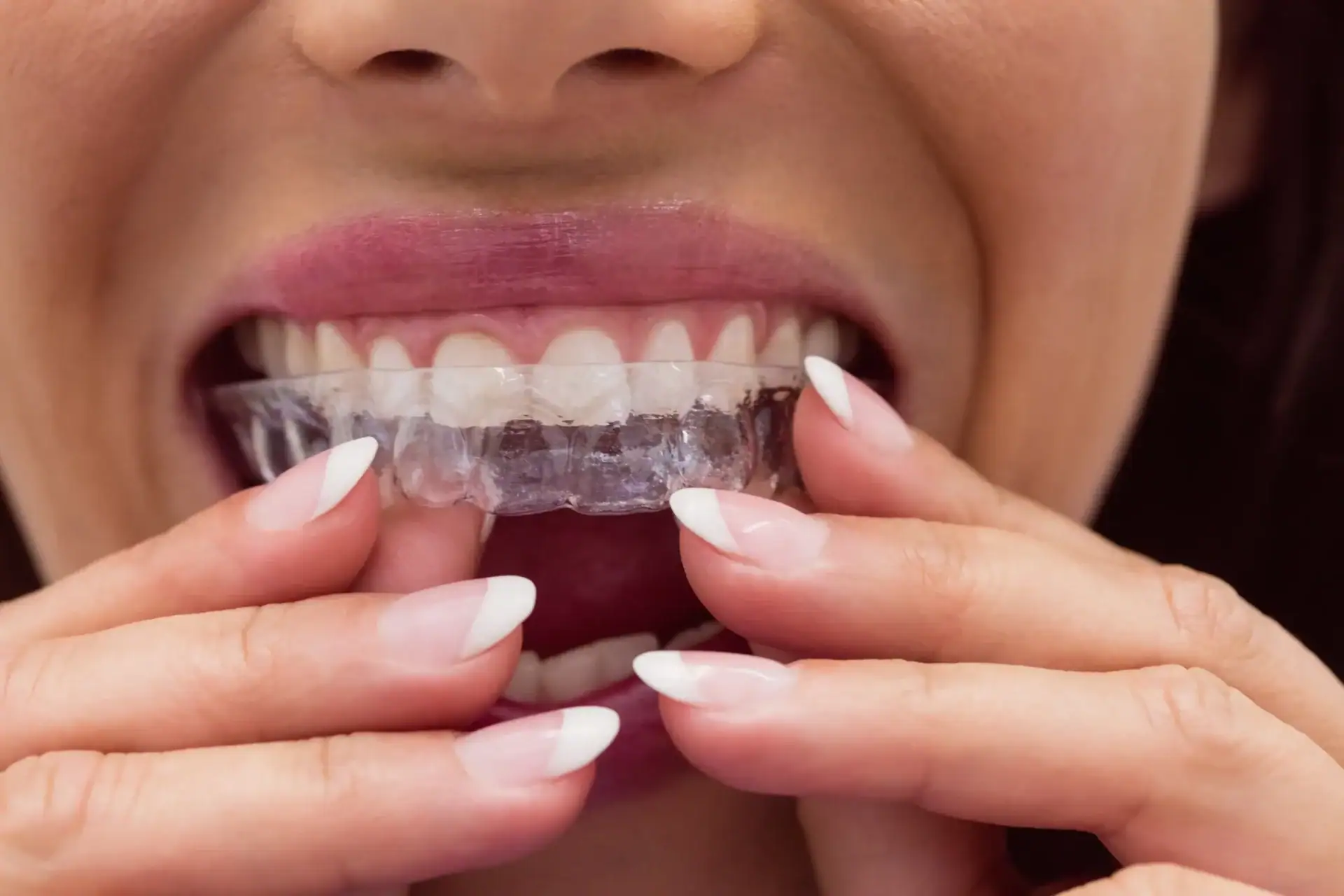 Escaneo digital iTero de los dientes de un paciente usado para planificar el tratamiento con Invisalign