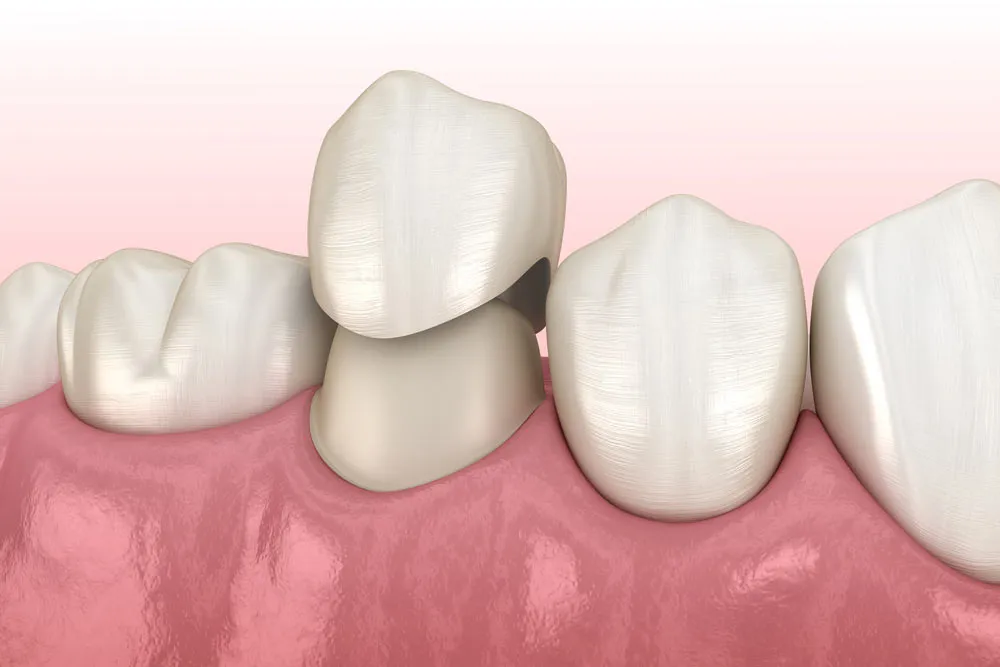 BruxZir Crown Neola Dental