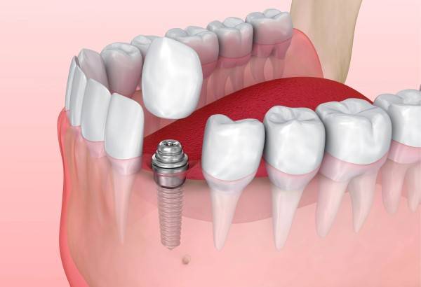 Implant supported crowns