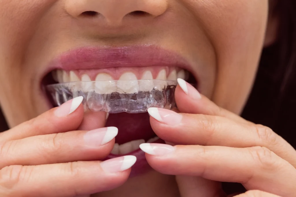 What is Invisalign and how does it work