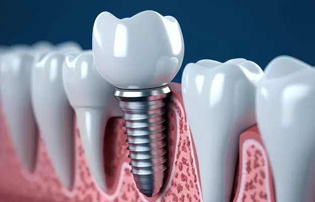 dentail implants 1