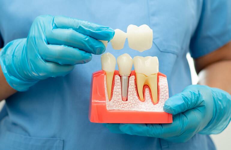 types of dental crowns